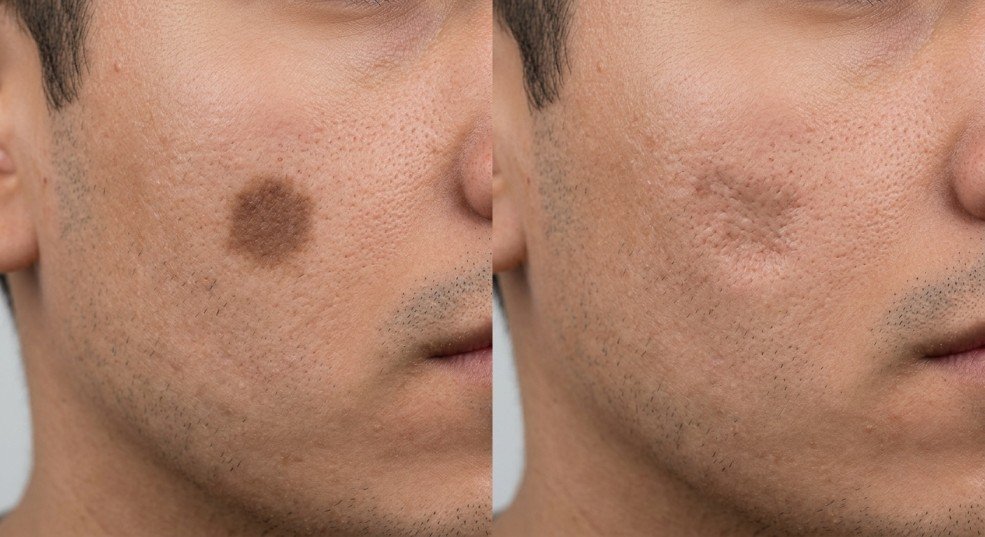 Dark spots vs acne scars a quick difference